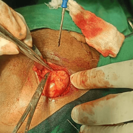Advanced ENT Surgery Procedure