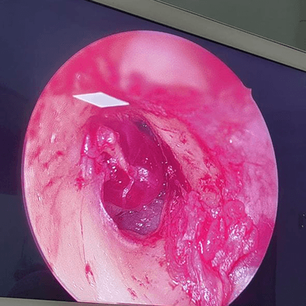 Advanced ENT Surgery Procedure